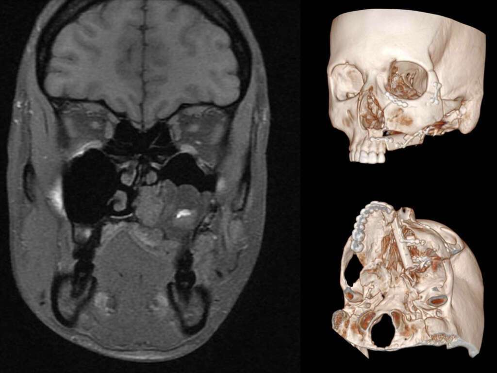 Left: Pre operative MRI. Right: CT-scan 3D reconstruction after surgery